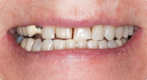 Close up of slightly misaligned and discolored teeth