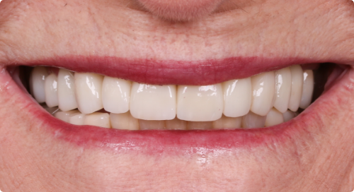 Close up of smile with brighter teeth