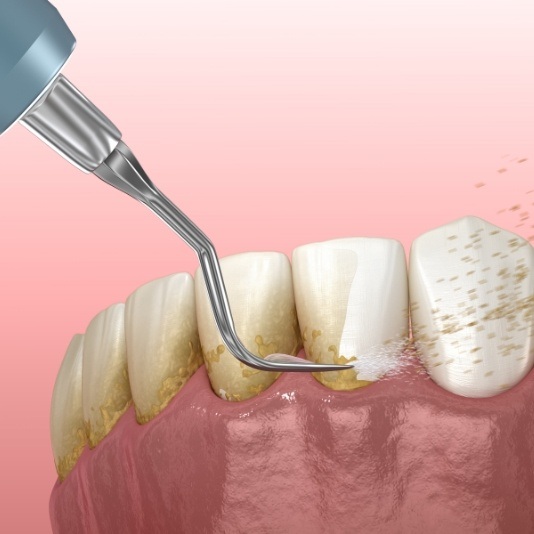 Animated dental tool removing plaque from teeth during gum disease treatment in Slidell