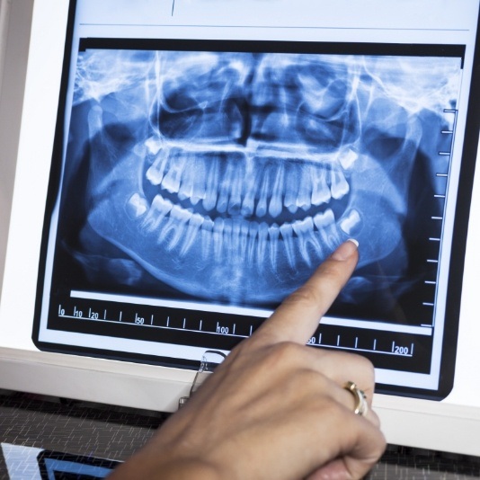 Dentist pointing to a digital dental x ray