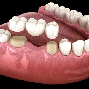 A 3 D illustration of a traditional dental bridge