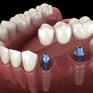 A 3 D illustration of an implant dental bridge