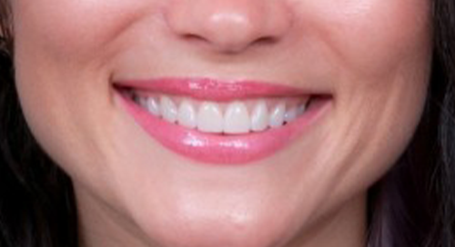 Close up of teeth after smile makeover