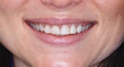 Close up of teeth before smile makeover