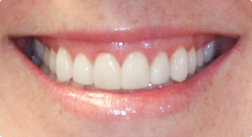 Close up of gummy smile