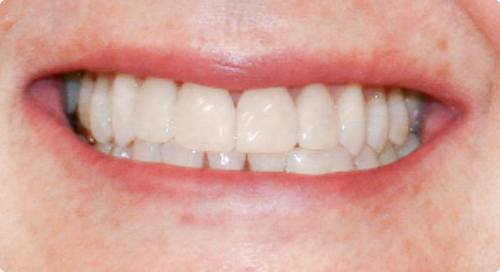 Close up of flawless teeth after smile makeover