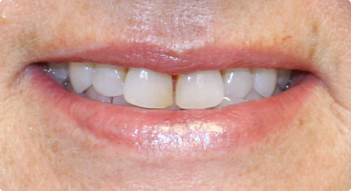 Close up of smile with slightly discolored and gapped teeth