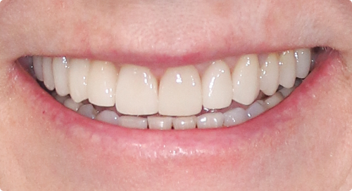 Close up of flawless smile after smile makeover