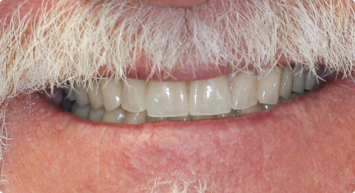 Close up of smile after dental prosthetic rehab