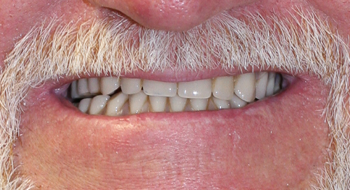 Close up of smile with some tooth discoloration