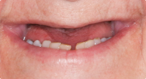 Close up of mouth with several missing teeth