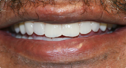 Close up of a smile with natural looking teeth