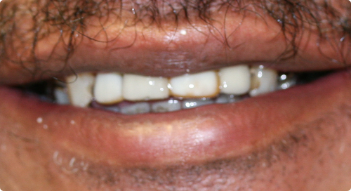 Close up of mouth with old metal dental restorations