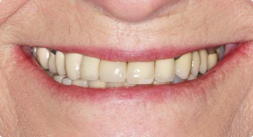 Close up of smile with discolored teeth