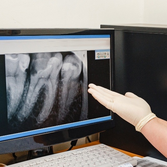 Cosmetic dentist pointing to digital image of teeth on computer screen