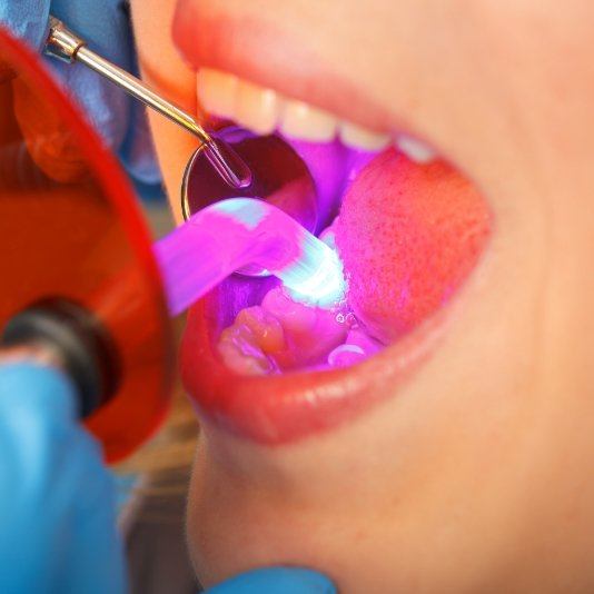 Close up of dental patient getting direct bonding from cosmetic dentist