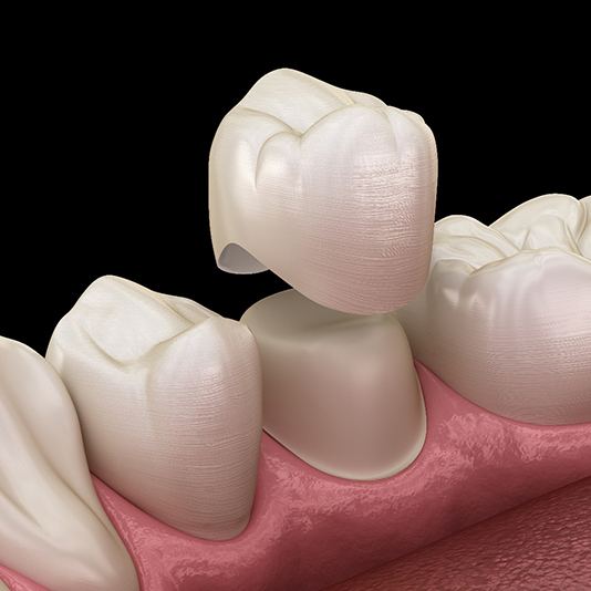 Illustration showing a dental crown sliding over a tooth