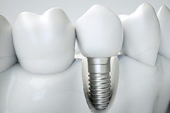 Illustration of dental implant in jawbone