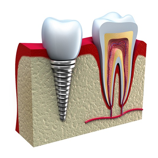 3 D diagram of a dental implant