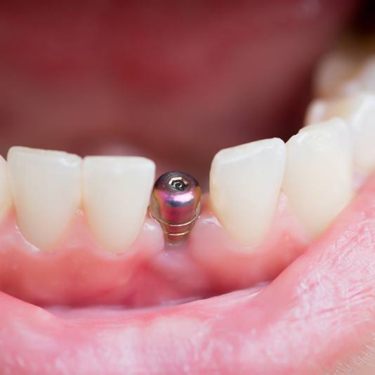Closeup of a mouth with a visible dental implant in Slidell