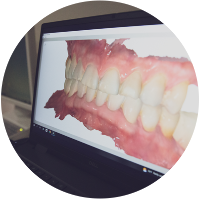 Close up photo of dental patients teeth on computer screen