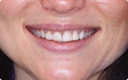 Close up of smile with imperfect teeth before treatment from Slidell dentist
