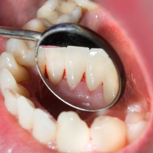 Close up of dental mirror inside mouth