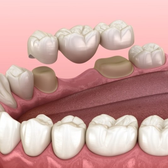 Animated dental bridge replacing a missing tooth in Slidell