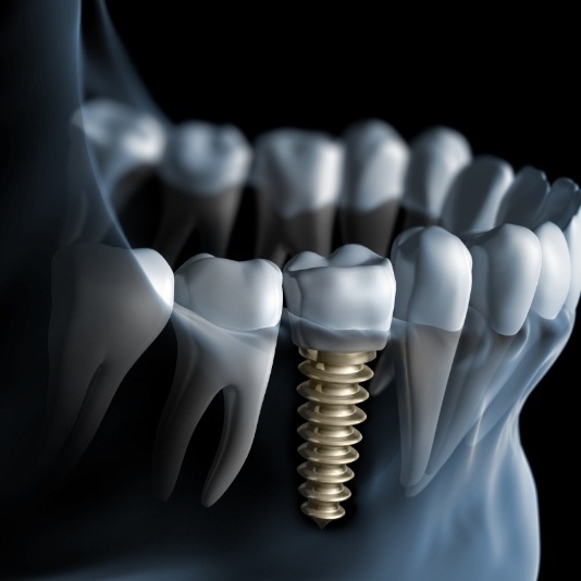 Animated X ray of a person with a dental implant