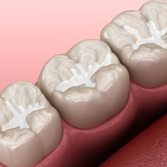 Illustrated row of teeth with tooth colored fillings