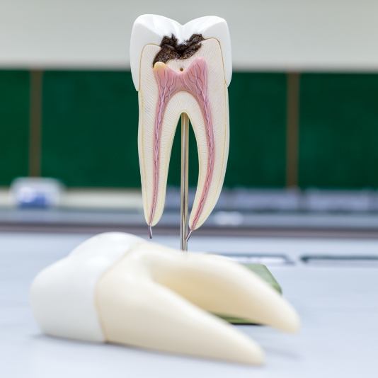 Model of damaged tooth that needs root canal treatment
