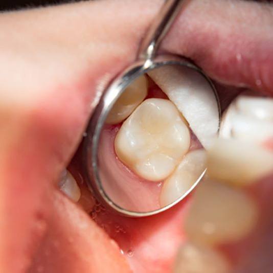 Dental mirror in a mouth reflecting a tooth with a tooth colored filling