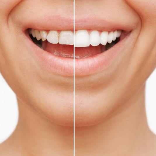 Closeup of patient's smile before and after veneers