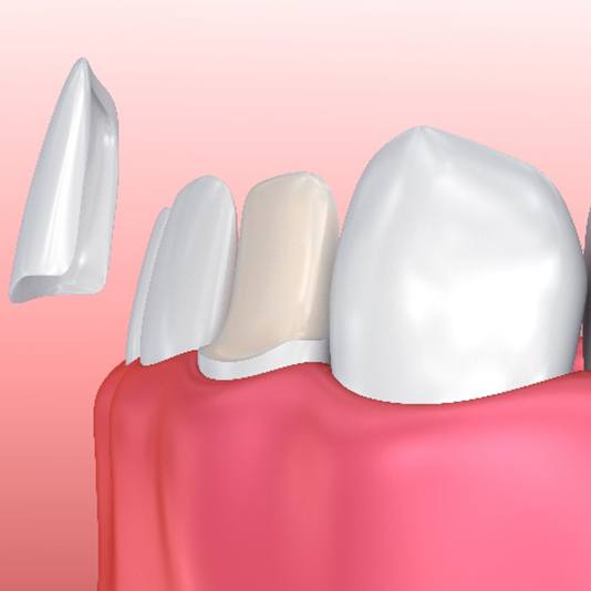 Closeup of patient's smile before and after veneers
Illustration of veneer being placed on bottom, front tooth
