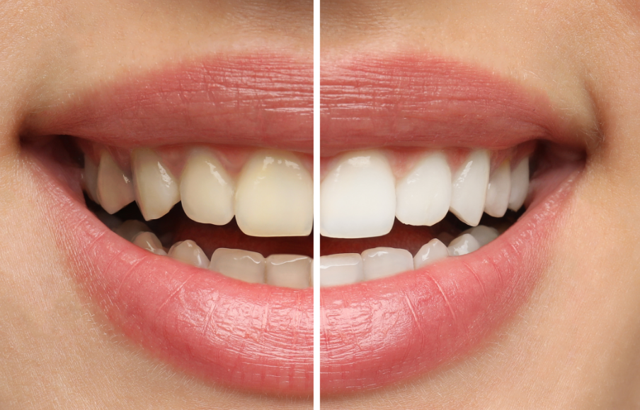 Woman's smile, half white teeth, half discolored
