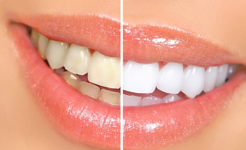 Woman's smile with half whitened teeth, half unwhitened