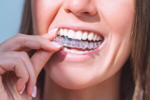 Woman holding clear aligner in mouth. 